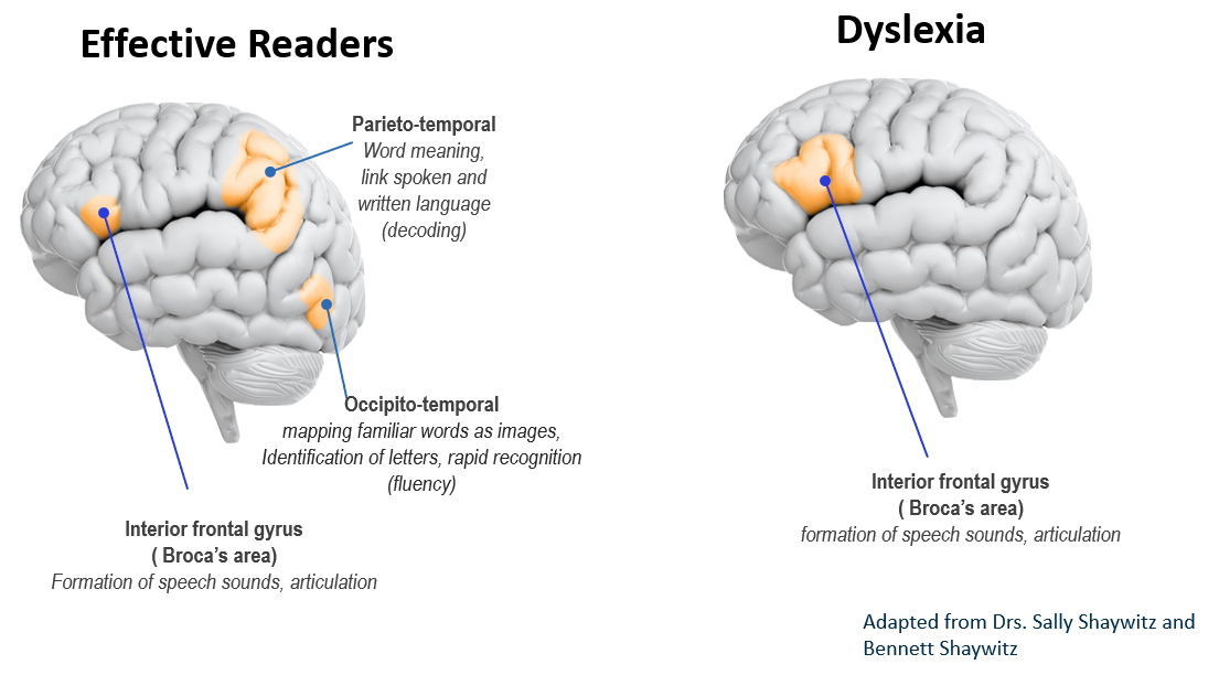 Brain-activity comparison showing under-activated left-hemisphere language centers in readers with dyslexia